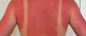 Hver anden dansker bliver solskoldet på sommerferien i Danmark