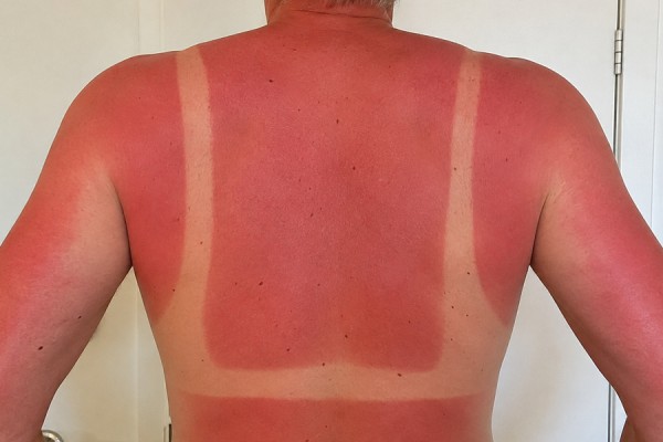 Hver anden dansker bliver solskoldet på sommerferien i Danmark